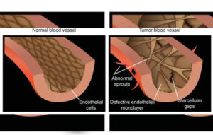Blood Vessel Abnormalities diagram