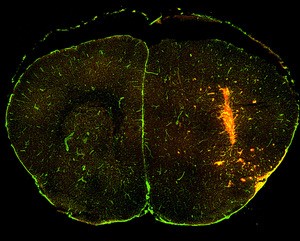The brain image shows mCherry+ melanoma cells (red) that have dispersed and invaded by migrating along the brain vasculature (green). - Courtesy of Dudley lab